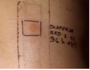 Patch test per determinare l’eventuale reazione allergica