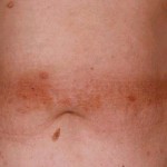 Tipica reazione allergica Typical allergic reaction