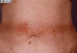 Tipica reazione allergica Typical allergic reaction